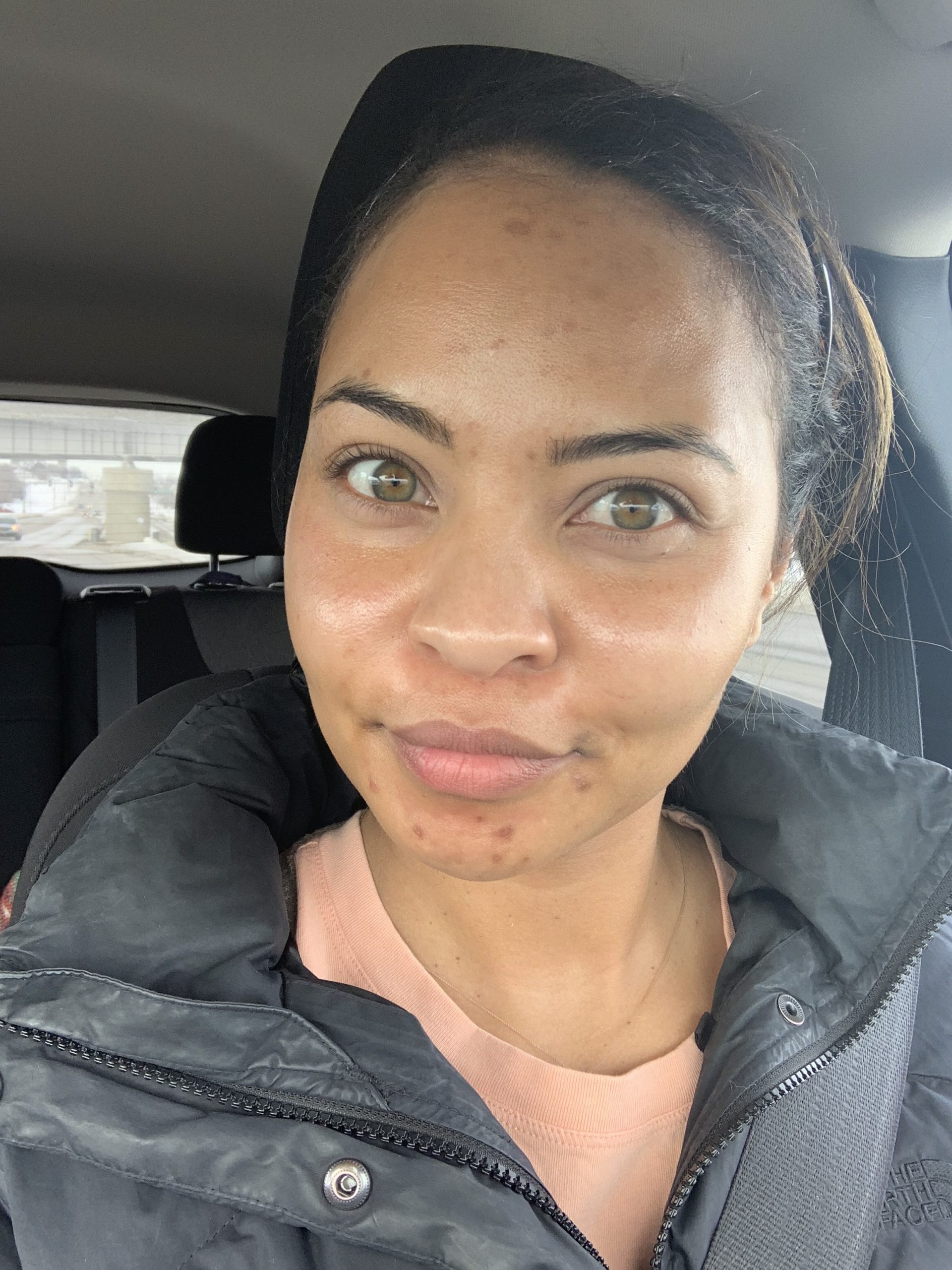 Examples of my hormonal acne leaving hyperpigmentation