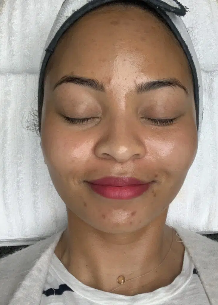 Examples of my hormonal acne's hyperpigmentation scars right before I got a chemical peel.